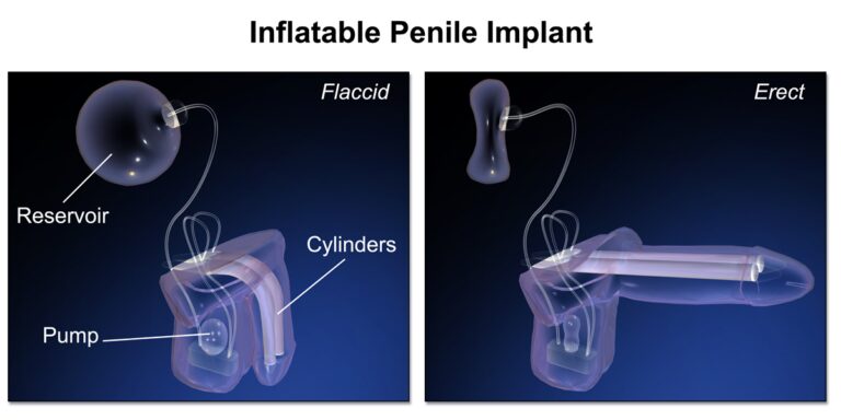 What Is Penile Injection Treatment And Penile Prosthesis Surgery