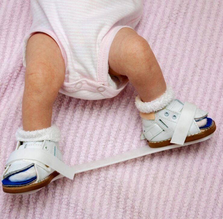 what-is-clubfoot-and-how-is-it-treated-an-overview-youtube